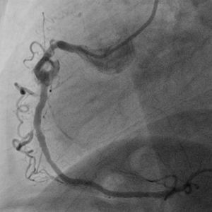 Giant aneurysm in the mid segment of the right coronary artery, involving the proximal portion of the stent, with a luminal thrombus.