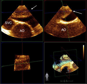 Mid-esophageal orthogonal views of the superior vena cava (SVC), ascending aorta (AO) and right pulmonary artery. Three-dimensional (3D) transesophageal echocardiography shows a large thrombus in the right pulmonary artery (white arrow), extending from the main pulmonary artery bifurcation. 3D reconstruction improves the morphological characterization of the thrombus.