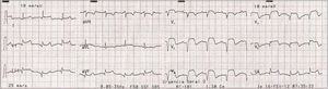 12-lead electrocardiogram showing sinus rhythm, Q waves and ST-segment elevation in the precordial leads DII and DIII.