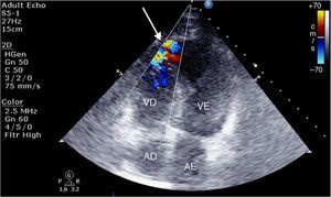 Transthoracic echocardiogram showing turbulent apical flow (arrow) due to interventricular septal rupture (peak velocities on continuous Doppler <3 m/s). AD: right atrium; AE: left atrium; VD: right ventricle; VE: left ventricle.