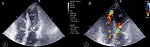 Transthoracic echocardiogram showing systolic anterior motion of the mitral valve (A, arrow), together with hypercontractility of the basal segments, causing dynamic obstruction of the left ventricular outflow tract, as demonstrated by turbulent flow in the outflow tract (B, arrow).
