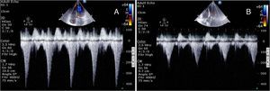 Quantification of dynamic gradients in the left ventricular outflow tract before (A) and after (B) discontinuation of dobutamine and administration of intravenous propranolol (1 mg/kg). The peak gradient in (A) is >64 mmHg with blood pressure of 90/60 mmHg; in (B) the peak gradient has fallen to 16 mmHg and blood pressure has risen to 110/70 mmHg.