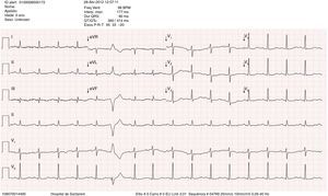Admission electrocardiogram showing sinus tachycardia with low voltage in the limb leads and nonspecific alterations in ventricular repolarization.