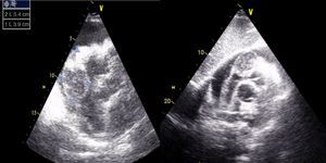 Two-dimensional transthoracic echocardiography in subcostal view showing large circumferential pericardial effusion and an oval, heterogeneous mass measuring 54 mm×39 mm at the level of the right atrioventricular groove, together with thickening of the right ventricular free wall.