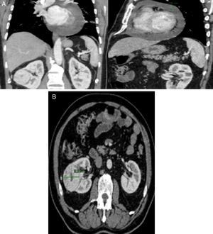 Thoracic-abdominal-pelvic computed tomography showing a lesion with contrast uptake at the level of the right atrium (A) and a solid, nodular lesion in the right kidney (B).