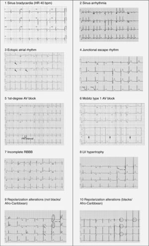 Electrocardiographic patterns associated with athlete's heart. AV: atrioventricular; HR: heart rate; LV: left ventricular; RBBB: right bundle branch block. Adapted from Drezner et al.5