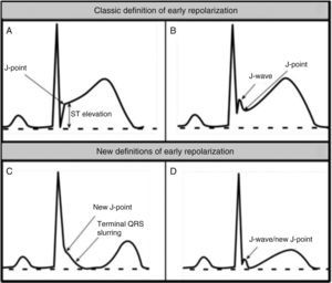 (A and B) Classic definition of early repolarization based on ST elevation at QRS end (J-point); examples without (A) and with (B) a J-wave; (C and D) new definitions of early repolarization showing slurred QRS downstroke and new J-point (C) and J-wave (D) without ST elevation. Adapted from Drezner et al.5