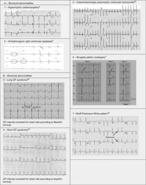 Electrocardiograms illustrating some structural and electrical cardiac abnormalities associated with sudden cardiac death.