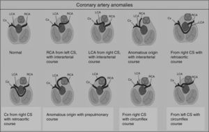 Illustration of congenital coronary artery anomalies. CS: coronary sinus; Cx: circumflex artery; LCA: left coronary artery; RCA: right coronary artery.