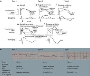 (A) Schematic representation of right ventricular epicardial action potential changes proposed to underlie the electrocardiographic manifestations of Brugada syndrome (adapted from Antzelevitch et al.49); (B) The three electrocardiographic patterns associated with Brugada syndrome: type 1 – coved ST-segment elevation of ≥2 mm followed by a negative T wave with little or no isoelectric separation in one or more right precordial leads (V1–V3); type 2 – ST-segment elevation followed by a positive or biphasic T wave, resulting in a saddleback configuration; and type 3 – ST-segment elevation in the right precordial leads of <1 mm, coved or saddleback configuration; diagnostic criteria for Brugada syndrome (adapted from Sheikh and Ranjan51).