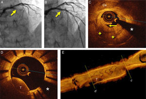 (A) Coronary angiography in cranial view showing the occluded left anterior descending coronary artery (arrow); (B) final angiographic result after bioresorbable vascular scaffold deployment; (C) optical coherence tomography (OCT) image after thrombus aspiration showing heterogeneous intrastent tissue with large lipid pools (+). Some stent struts are poorly detected due to attenuation. There is also calcified tissue (Ca) surrounding some struts. Note plaque rupture (arrow); (D) OCT image after thrombus aspiration showing residual red thrombus (T) in an area with complete neointimal coverage. (*) denotes wire artifact; (E) 3D reconstruction of OCT image after thrombus aspiration with severe stenosis due to intrastent tissue (c) and residual red thrombus (T) (d).