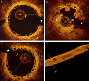 (A) Optical coherence tomography (OCT) findings after bioresorbable vascular scaffold (BVS) implantation. The device was fully expanded and apposed. The metallic struts of the underlying stent are clearly detected (posterior shadow) in the far field; (B) OCT findings during BVS thrombosis, with large platelet-rich thrombus (pT) occupying the lumen and the characteristic box-like appearance of the BVS struts; (C) OCT after six months. Notice complete neointimal coverage of struts. (*) denotes wire artifact; (D) 3D reconstruction of OCT image after six months.