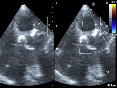 Left ventricular calcification in a patient with endomyocardial ...