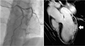 Coronary angiography showing subocclusive lesion of the obtuse marginal artery (left) and subendocardial late enhancement of the left ventricular posterior wall, compatible with an infarction scar (right).