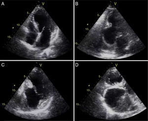 Two-dimensional transthoracic echocardiography: (A) apical 4-chamber view showing no alterations; (B) apical 2-chamber view revealing a giant ventricular inferior wall aneurysm containing a thrombus; (C) modified apical 2-chamber view showing intact subvalvular mitral apparatus; (D) modified apical 3-chamber view showing a large ventricular posterior wall aneurysm containing a thrombus.