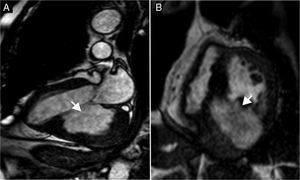 Cardiac cine steady-state free precession magnetic resonance imaging: (A) long-axis view showing a giant ventricular aneurysm (long axis 6.7 cm) of the posterior wall (arrow) containing a thrombus; (B) short-axis view above the level of the papillary muscles showing a large ventricular aneurysm of the inferoposterior wall (arrow), containing a thrombus.