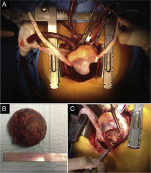 Intraoperative photographs following median sternotomy: (A) large aneurysm of the left ventricular inferior wall; (B) wall thrombus removed from ventricular aneurysm; (C) aneurysm neck closed with a Dacron® patch.