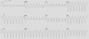 12-lead electrocardiogram revealing ventricular tachycardia, with a rate response of approximately 170 bpm and a pattern of right bundle branch block.