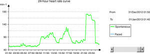 Heart rate curve revealing sudden high ventricular rates, consistent with the reported episode of ventricular tachycardia.
