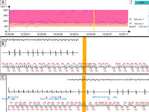 Intracardiac electrograms and tachograph of the last stored episode, dated 11 December, 2012. (A) Tachogram showing some irregularity in atrial waves but regularity of ventricular activity; (B and C) electrograms revealing changes in morphology and regularity of the RR interval and successive alternation of rhythm classification between supraventricular tachyarrhythmia/ventricular tachycardia and ventricular tachycardia with long cycle length.
