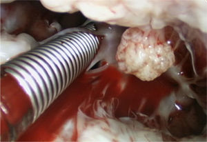 On operative inspection, the lesion was between the anterior mitral leaflet and primary chordae.