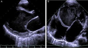 (A) Transthoracic echocardiogram in long-axis parasternal view showing prominent trabeculations separated by deep recesses in the left ventricular lateral wall; (B) transthoracic echocardiogram in apical 4-chamber view showing left ventricular lateral wall and apical trabeculation.