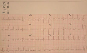 ECG showing 2 mm ST elevation, with Q waves and T-wave inversion, in V1–V2. ST depression can also be observed in the inferolateral leads.