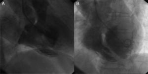 Ventriculography showing the presence of a shunt with contrast passing from left to right ventricle (A) and leading to the initial identification of a septal defect (B).