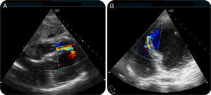 Transthoracic echocardiography confirming the presence of a ventricular septal defect and showing the location of the ruptured region in subxiphoid (A) and apical 4-chamber views (B).