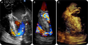 Transesophageal echocardiography performed after surgical repair enabling diagnosis of the cause for the patient's sudden worsening by visualization of complete suture dehiscence allowing flow from left to right ventricle (A), confirmed in color 3D images (B) and 3D reconstruction (C).