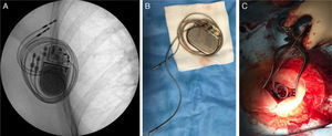 (A) Chest X-ray showing coiling of the pacing leads around the pulse generator; (B) removal of the pacing system with the leads coiled around the pulse generator; (C) in-situ anti-manipulation fixation.