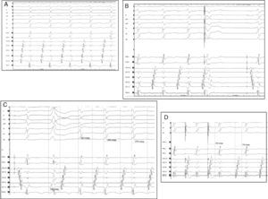 (A) Surface ECG (aVF, V1 and V6) and intracardiac bipolar recordings during tachycardia. A supraventricular tachycardia with a long RP interval and earliest atrial activation along the mitral annulus (CS1–2) is seen; (B) ventricular extrastimuli at shorter coupling intervals from the right ventricle at a time when the His bundle is known to refractorily terminate the tachycardia without reaching the atrium; (C) the tachycardia is induced with a single premature beat from the left ventricle, showing slow and decremental conduction properties. Abl: ablation; CS: coronary sinus (1–2 distal; 9–10 proximal); His p: proximal His; His d: distal His; RVAp: right ventricular apex.