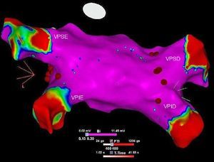 Voltage map in sinus rhythm, visualized from the left atrial posterior wall using the CARTO® system. VPID: right inferior pulmonary vein; VPIE: left inferior pulmonary vein; VPSD: right superior pulmonary vein; VPSE: left superior pulmonary vein; purple area: normal voltage; red area: low voltage.