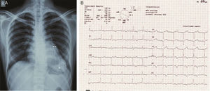 (A) Chest radiograph in posteroanterior view showing large calcified left ventricular apical aneurysm (*) and basal aneurysm (**); (B) electrocardiogram showing no pathological Q waves and normal progression of precordial R wave.