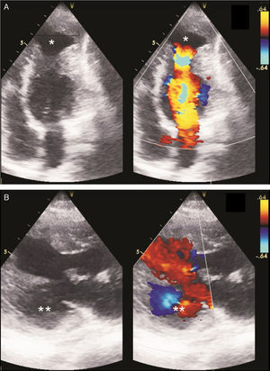 Transthoracic two-dimensional echocardiogram with color Doppler. (A) Apical 4-chamber view in systole showing apical aneurysm (*); (B) parasternal long-axis view in diastole showing submitral aneurysm (**).