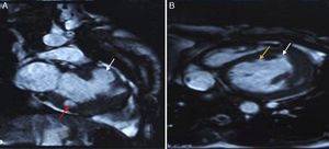 Cardiac magnetic resonance imaging. (A) Bright-blood image showing apical aneurysm (white arrow) and submitral aneurysm (red arrow) in vertical long-axis view; (B) bright-blood image showing apical aneurysm (white arrow) and anterior aneurysm (yellow arrow) in 4-chamber view.
