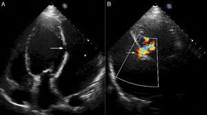 Pre-procedural echocardiographic images. (A) Apical 4-chamber view showing large pseudoaneurysm (asterisk) with neck (long arrow) 14 mm wide; (B) apical long-axis view with color Doppler showing turbulent flow across the defect (small arrow).