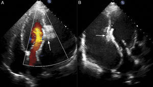 Post-procedural echocardiographic images in apical 4-chamber (A) and long-axis (B) view with color Doppler showing defect completely closed by Amplatzer septal occluder (arrows).