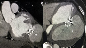 (A) and (B) Cardiac computed tomography performed after six months showing complete closure of the defect by Amplatzer septal occluder (arrows). The asterisks indicate partially thrombosed pseudoaneurysm.