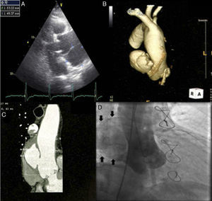 Imaging of ascending aortic pseudoaneurysm. (A) Transthoracic echocardiography showing ascending aortic pseudoaneurysm in parasternal view; (B) three-dimensional computed tomography (CT) reconstruction of aorta; (C) CT scan with intravenous contrast showing the dimensions of the neck and cavity of the pseudoaneurysm; (D) aortography with contrast opacification of pseudoaneurysm cavity (solid arrows).