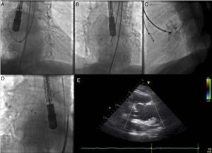 Images illustrating percutaneous closure of aortic pseudoaneurysm. (A) Left internal mammary diagnostic catheter inside the delivery sheath engaging the pseudoaneurysm cavity; (B) Amplatzer atrial septal defect (ASD) occluder with the distal disk opened inside the pseudoaneurysm cavity, and the proximal disk misshapen inside the aortic lumen; (C) Amplatzer ASD device deployed across the aortic wall defect; (D) Amplatzer ASD device released in a stable position; (E) transthoracic echocardiography showing position of the device without interfering with the bioprosthesis.