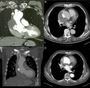 Evolution over time of ascending aortic pseudoaneurysm closure. (A and B) Computed tomography (CT) scan at one month showing Amplatzer ASD device in a stable position and organizing thrombus inside the pseudoaneurysm cavity; (C and D) CT scan at one year with device maintaining its position and partial resolution of the excluded pseudoaneurysm cavity.