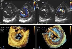 (A and B) Two-dimensional transesophageal echocardiography, transgastric view, showing trifoliate configuration of the left AV valve and the ‘cleft’ (*) in diastole (A); mitral regurgitation from the ‘cleft’ in systole (B); (C and D) real-time three-dimensional zoom, cropped images: in diastole, atrial view (C) and ventricular view (D), the morphology of the three leaflets of the left AV valve can be seen in detail, as well as the septal orientation (towards the right ventricle) of the ‘cleft’. Abnormal chordal attachments linking the edges of the ‘cleft’ to the interventricular septum can be clearly seen in ventricular view (arrow). Other features of a left atrioventricular valve can be seen – elliptical annulus and small mural leaflet. 1: anterosuperior leaflet; 2: posteroinferior leaflet; 3: mural leaflet; AOV: aortic valve; LVOT: left ventricular outflow tract; TV: tricuspid valve.