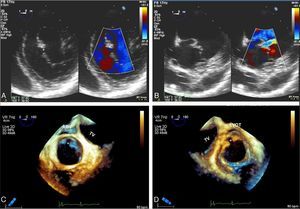 (A and B) Two-dimensional transesophageal echocardiography, transgastric view, showing mitral valve anterior leaflet cleft (*) in diastole (A) and in systole (B); (C and D) real-time three-dimensional zoom, cropped images: in diastole, anterior leaflet cleft in atrial view (C) and ventricular view (D). Note the typical orientation of the cleft towards the left ventricular outflow tract.