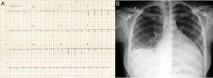 12-lead electrocardiogram (A) and chest X-ray in anteroposterior view (B).