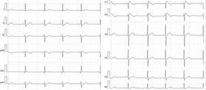 ECG of a male showing early, high take-off (>2 mm) down-sloping ST elevation (coved type) in V1–2 gradually descending into an inverted T wave, suggestive of Brugada pattern.