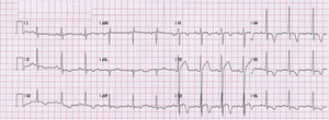 ECG of a young male elite athlete with apical variant hypertrophic cardiomyopathy, showing symmetric T-wave inversion in V3–V6 and ST elevation with J-point elevation in V2–V3, suggestive of early repolarization.