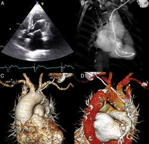 (A) Transthoracic echocardiography, apical 4-chamber view, showing the pacing lead passing through the aortic valve to insert in the left ventricular lateral wall; (B) thoracic computed tomography angiography (CTA), maximum intensity projection image, showing the entire trajectory of the pacing lead through the aneurysmal ascending aorta, aortic valve and left ventricle; (C) volume-rendered thoracic CTA showing pacing lead perforating the atheromatous aortic arch; (D) volume-rendered thoracic CTA showing perforation site between the left common carotid artery and the brachiocephalic trunk.
