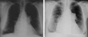 Chest radiographs from 1992 (left) and 2011 (right) showing mediastinal enlargement.