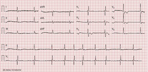Electrocardiogram, February 2012, showing atrial fibrillation with a ventricular rhythm of 63/min, and no significant ST-T abnormalities.
